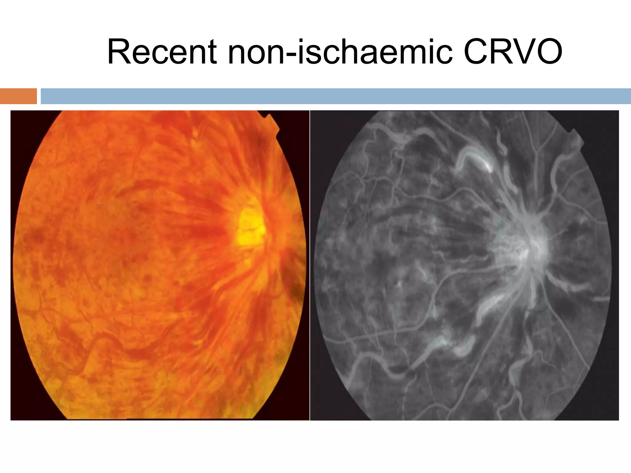 Retinal vascular occlusions | PPTX