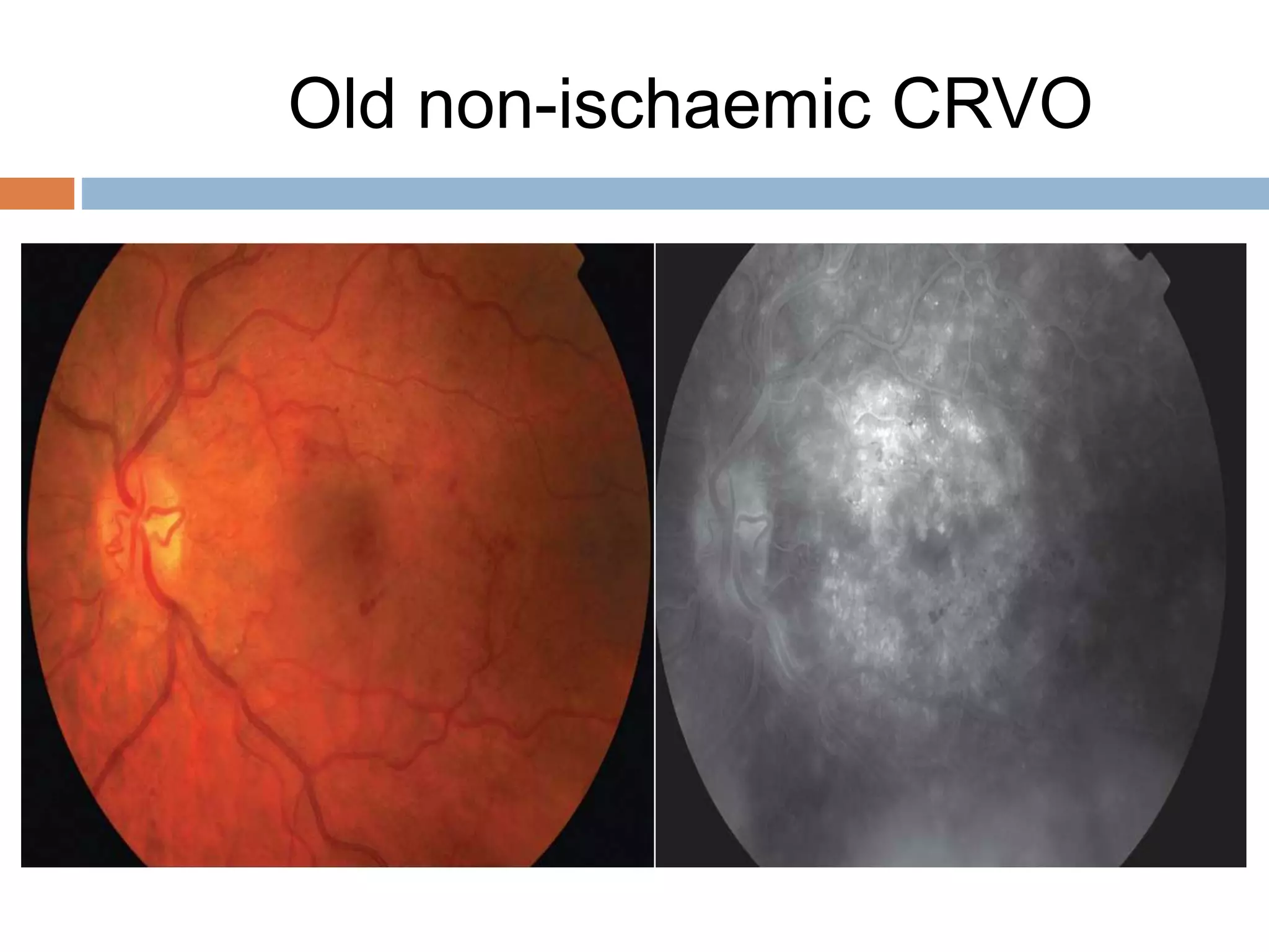 Retinal vascular occlusions | PPTX