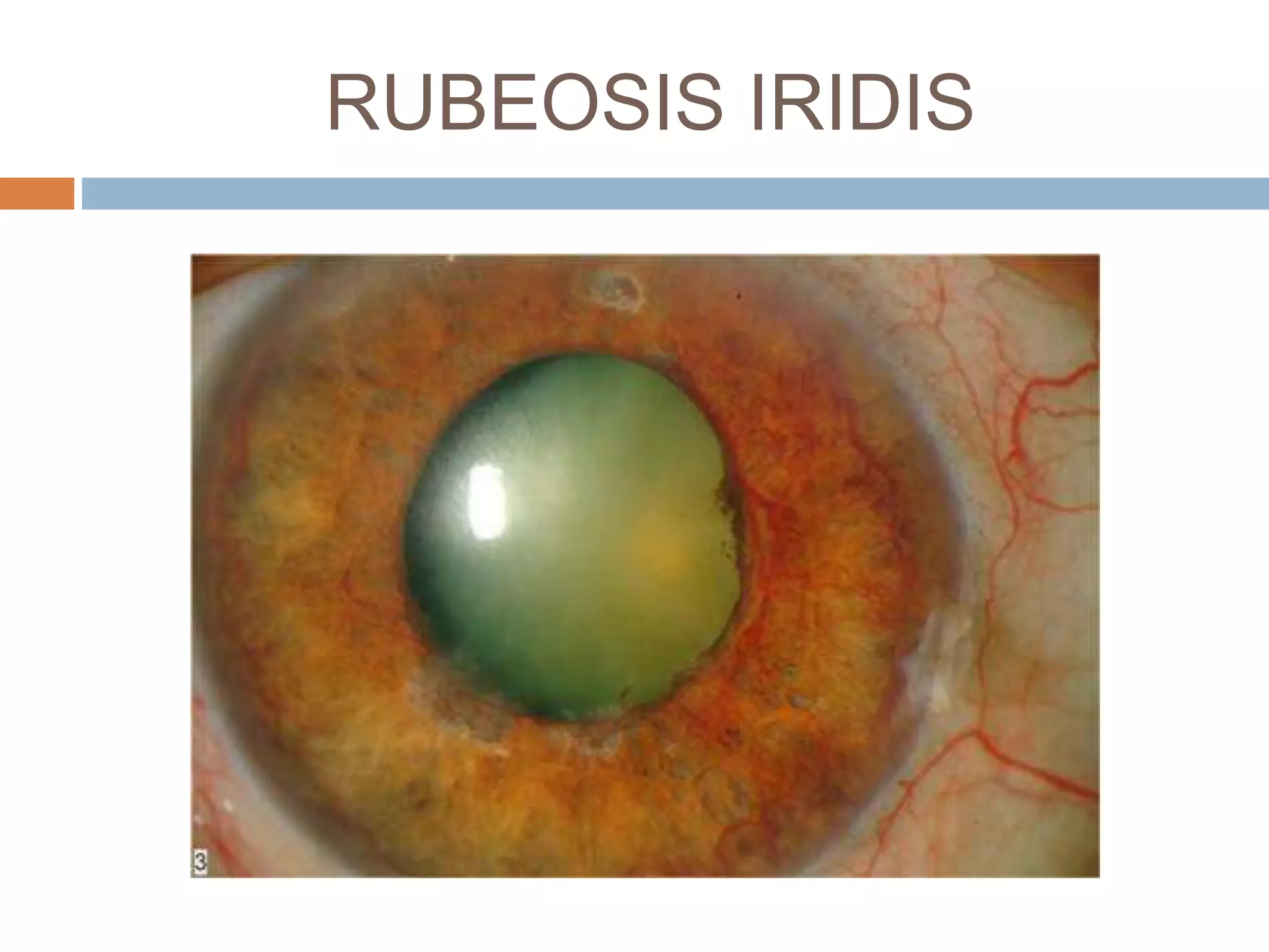 Retinal vascular occlusions | PPTX