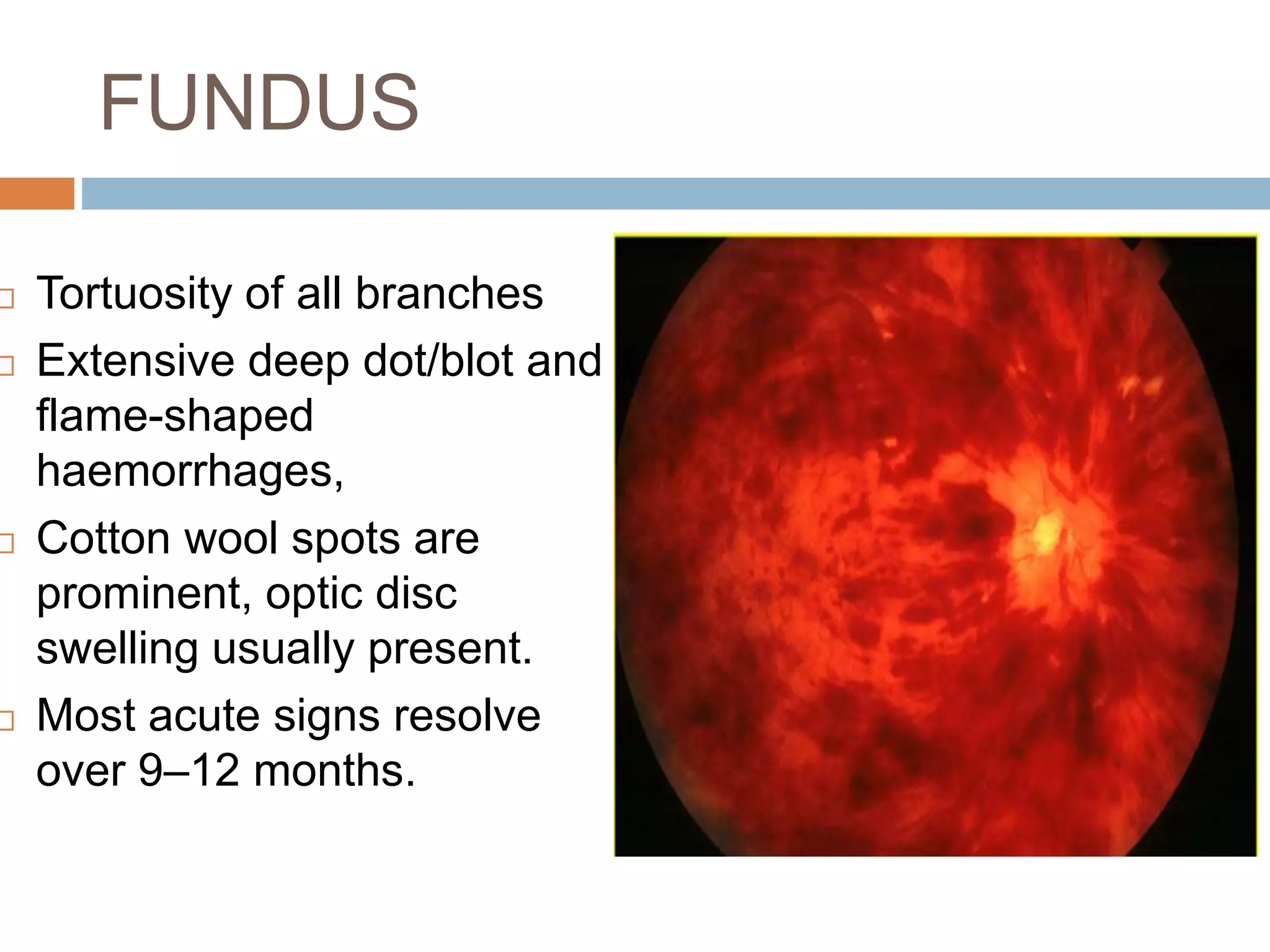 Retinal vascular occlusions | PPTX