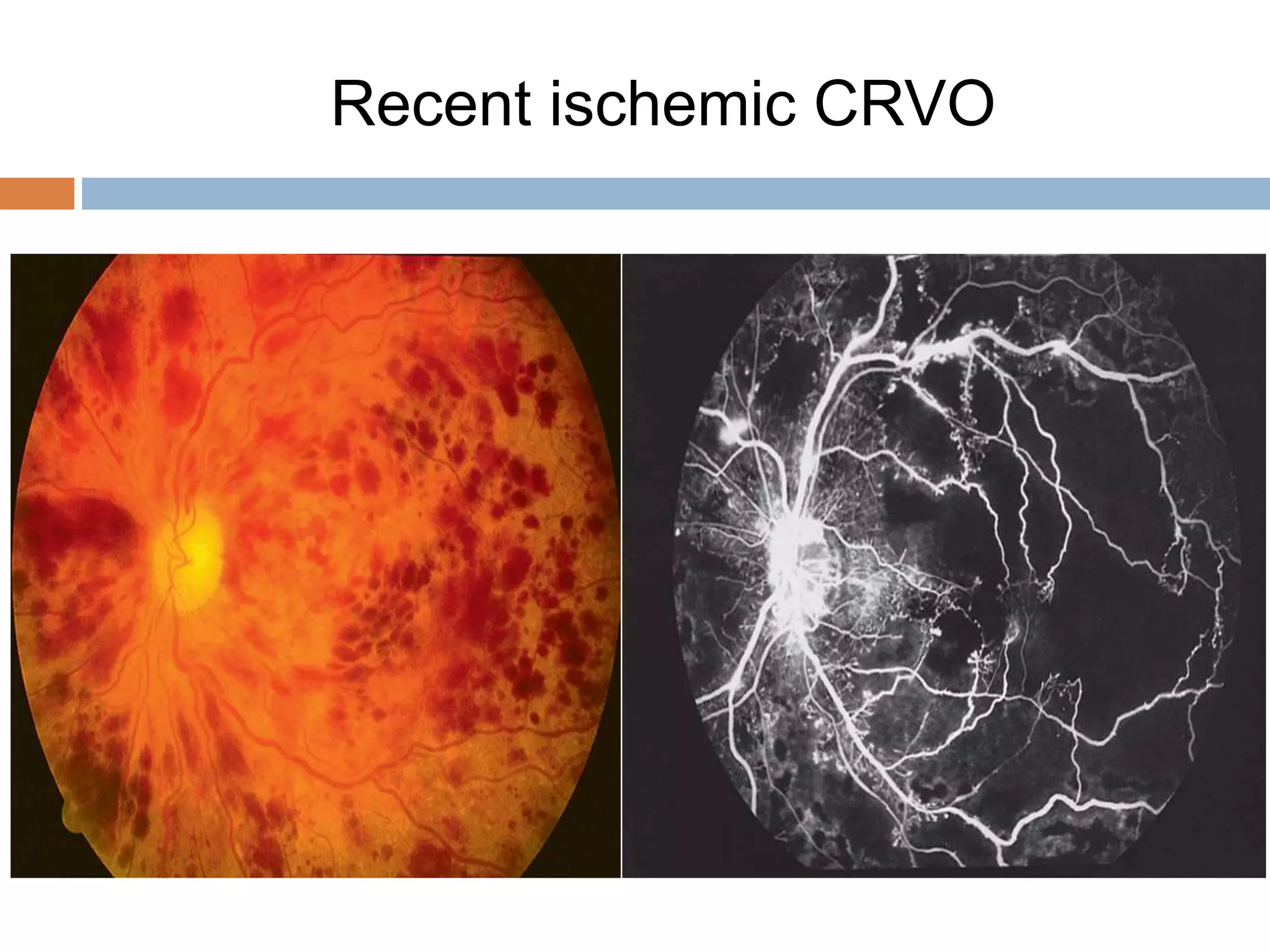 Retinal vascular occlusions | PPTX