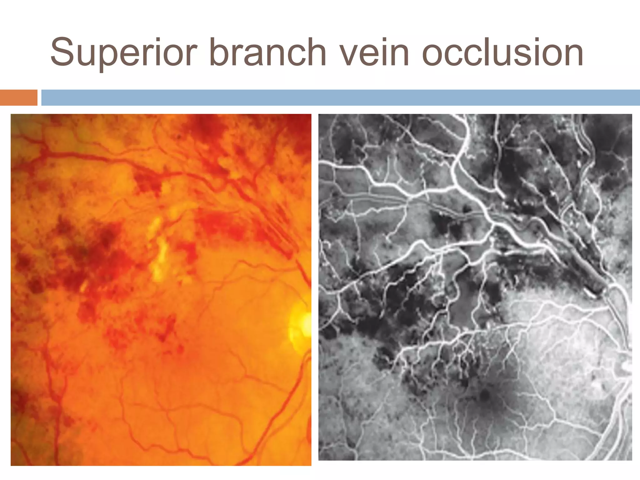 Retinal vascular occlusions | PPTX