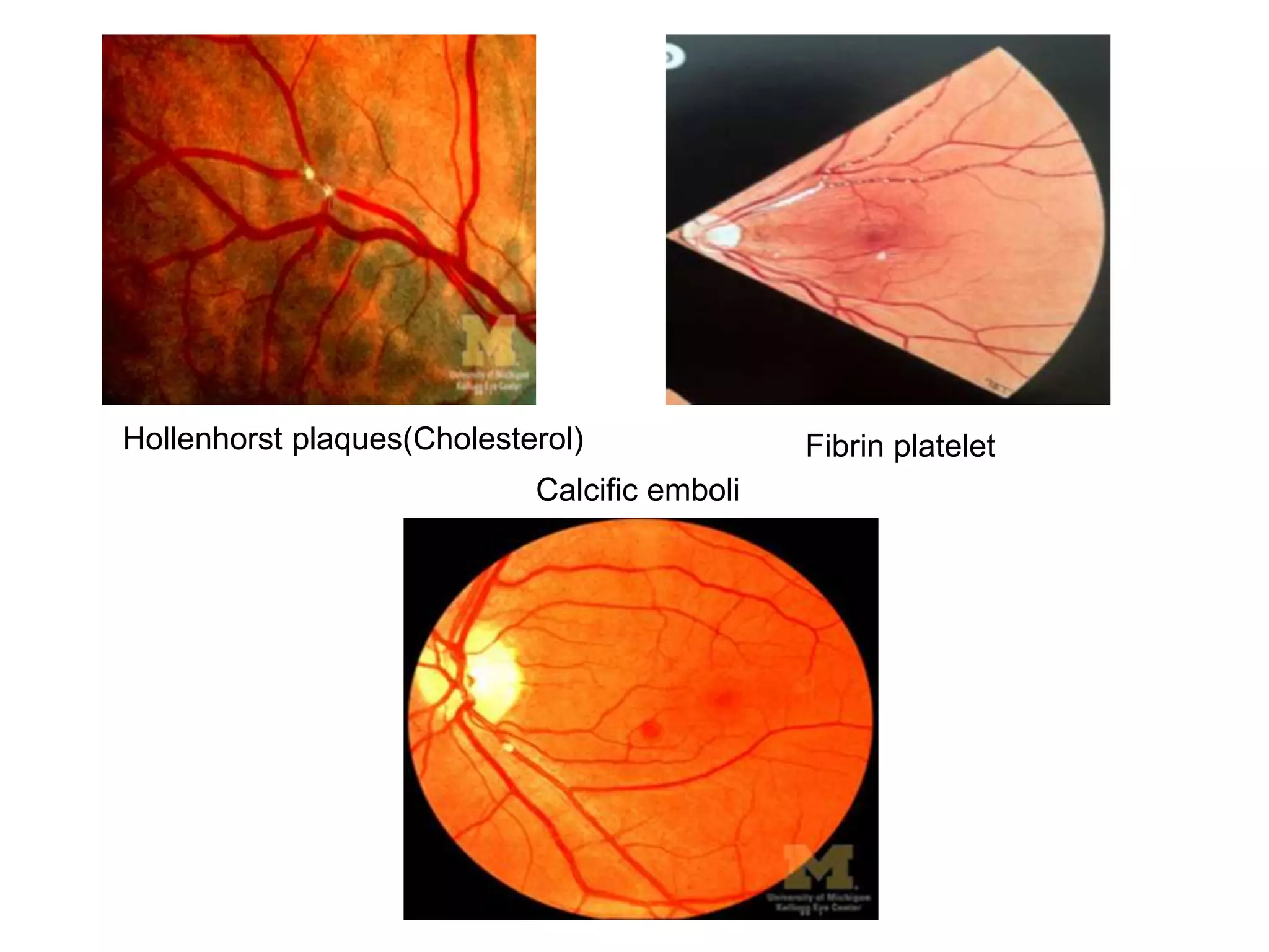 Retinal Vascular Occlusions PPTX Retinal Vascular Occlusions PPTX