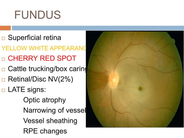 Retinal vascular occlusions | PPTX