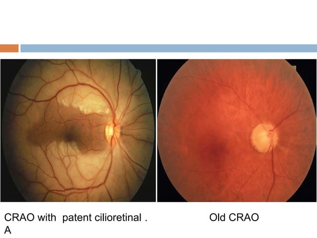 Retinal vascular occlusions | PPTX