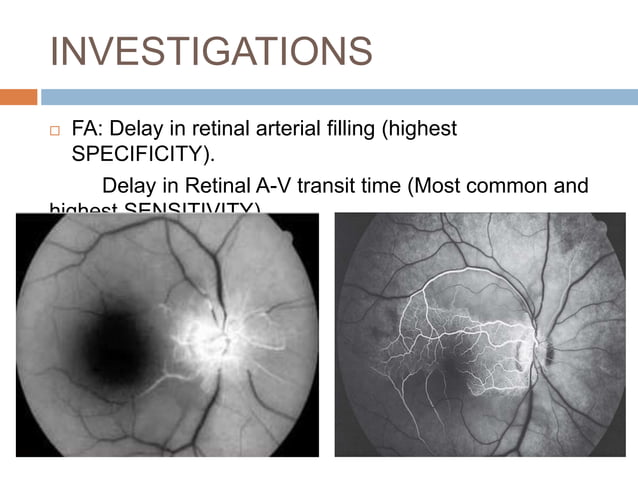 Retinal vascular occlusions | PPTX