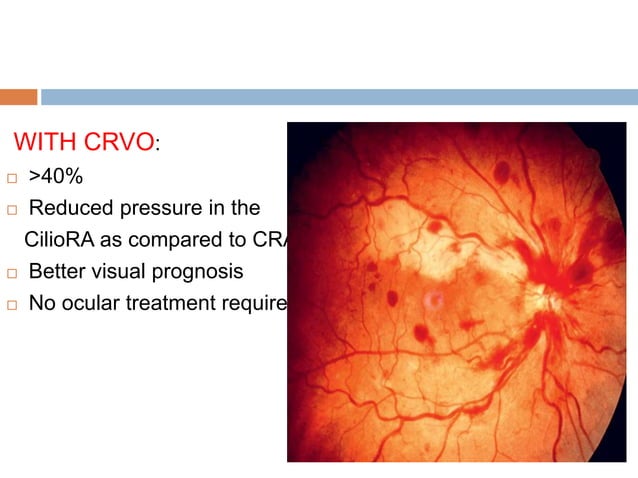 Retinal vascular occlusions | PPTX
