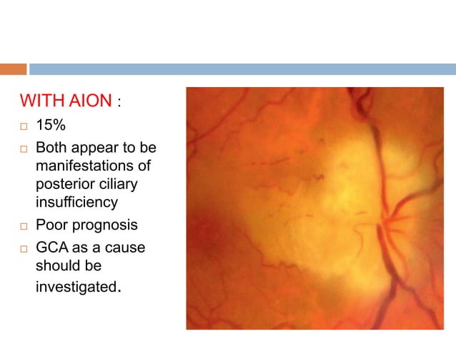 Retinal vascular occlusions | PPTX