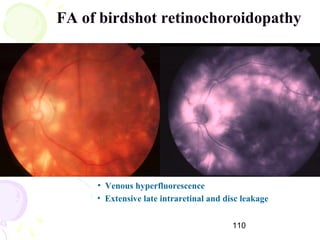 110
FA of birdshot retinochoroidopathy
• Extensive late intraretinal and disc leakage
• Venous hyperfluorescence
 