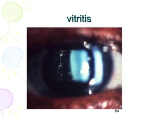 64
vitritisvitritis
 