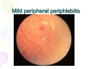 65
Mild peripheral periphlebitisMild peripheral periphlebitis
 