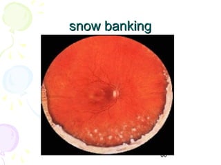 66
snow bankingsnow banking
 