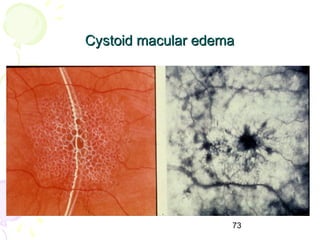 73
Cystoid macular edemaCystoid macular edema
 