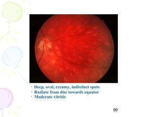 99
• Deep, oval, creamy, indistinct spots
• Radiate from disc towards equator
• Moderate vitritis
 