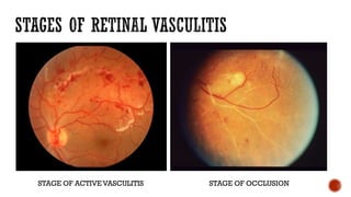 STAGE OF ACTIVE VASCULITIS STAGE OF OCCLUSION
 