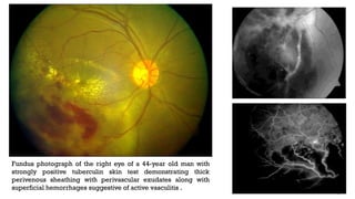 Fundus photograph of the right eye of a 44-year old man with
strongly positive tuberculin skin test demonstrating thick
perivenous sheathing with perivascular exudates along with
superficial hemorrhages suggestive of active vasculitis .
 