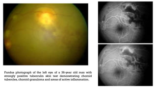 Fundus photograph of the left eye of a 36-year old man with
strongly positive tuberculin skin test demonstrating choroid
tubercles, choroid granuloma and areas of active inflammation.
 