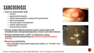  Can be associated with
 uveitis,
 episcleritis/scleritis,
 eyelid abnormalities, conjunctival granuloma,
 optic neuropathy,
 lacrimal gland enlargement
 orbital inflammation.
 Intermediate uveitis
 Young adults affects females more commonly with
bilateral hilar lymphadenopathy, ocular and skin lesions.
 Ocular involvement in 60% of systemic cases,
predominantly presenting as anterior granulomatous
uveitis.
 Retinal periphlebitis
 non occlusive associated segmental cuffing or “candle wax
drippings’’
Clinics in chest medicine. 2015;36(4):669-683. doi:10.1016/j.ccm.2015.08.009.
 