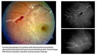 Fundus photograph of a patient with documented sarcoidosis
demonstrating segmental perivenous sheathing with hemorrhage.
FFA shows occlusive vasculitis and late phase leakage.
 