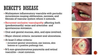  Multisystem inflammatory vasculitis with periodic
recurrences causing obliteration, necrosis, and
fibrosis of vascular system where it extends.
 Recurrent occlusive vasculopathy affecting both
(predominantly) veins and arterioles and
spontaneous remission.
 Oral and genital mucosa, skin, and eyes involved.
 Major clinical criteria :recurrent oral ulcerations.
 At least 2 other criteria:
 recurrent genital ulcerations, eye lesions, skin
lesions or a positive pathergy test.
 B/L non-granulomatous panuveitis and retinal
vasculitis – most common.
 