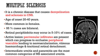 It is a chronic disease that causes demyelination
and sclerosis in CNS.
Age of onset 20-40 years.
More common in females.
 95 % cases are bilateral.
Retinal periphlebitis may occur in 5-10% of cases.
Active lesion: perivenular infiltrates are present
which can progress to occlusive peripheral
vasculitis leading to neovascularization, vitreous
haemorrhage & tractional retinal detachment.
Intermediate uveitis and panuveitis are the most
common categories of MS associated uveitis.
 