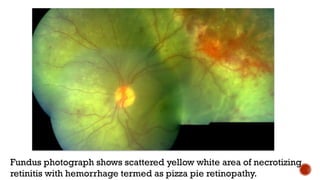 Fundus photograph shows scattered yellow white area of necrotizing
retinitis with hemorrhage termed as pizza pie retinopathy.
 