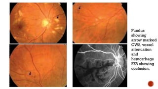 Fundus
showing
arrow marked
CWS, vessel
attenuation
and
hemorrhage
FFA showing
occlusion.
 