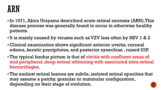 In 1971, Akira Urayama described acute retinal necrosis (ARN).This
disease process was generally found to occur in otherwise healthy
patients.
It is mainly caused by viruses such as VZV less often by HSV 1 & 2
Clinical examination shows significant anterior uveitis, corneal
edema, keratic precipitates, and posterior synechiae , raised IOP.
The typical fundus picture is that of vitritis with confluent areas of
mid peripheral, deep retinal whitening with associated intra-retinal
hemorrhages.
The earliest retinal lesions are subtle, isolated retinal opacities that
may assume a patchy, granular or nummular configuration,
depending on their stage of evolution.
 