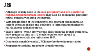 Although usually seen in the mid-periphery and pre-equatorial
regions, small nummular lesions may also be seen in the posterior
retina, generally sparing the macula.
With progression of the syndrome, the granular and nummular
lesions increase in size and coalesce to form confluent zones of
full-thickness retinal necrosis.
These lesions, which are typically situated in the retinal periphery,
may occupy as little as 1–2 clock hours or may extend to
completely encircle the retina over 360°.
Diagnosis is mainly clinical, PCR may be done in uncertainty.
Response to antiviral treatment is confirmatory.
 
