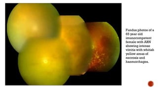 Fundus photos of a
65 year old
imunocompetent
female with ARN
showing intense
vitritis with whitish
yellow areas of
necrosis and
haemorrhages.
 
