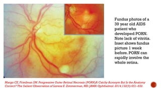 Fundus photos of a
39 year old AIDS
patient who
developed PORN.
Note lack of vitritis.
Inset shows fundus
picture 1 week
before. PORN can
rapidly involve the
whole retina.
Margo CE, Friedman SM.Progressive Outer Retinal Necrosis (PORN)A Catchy Acronym But Is the Anatomy
Correct? The Salient Observation of Lorenz E. Zimmerman,MD.JAMA Ophthalmol.2014;132(5):651–652.
 