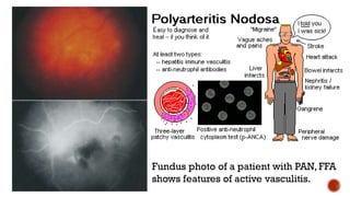 Fundus photo of a patient with PAN, FFA
shows features of active vasculitis.
 