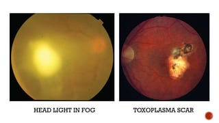 HEAD LIGHT IN FOG TOXOPLASMA SCAR
 