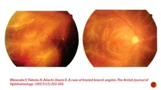WatanabeY,Takeda N,Adachi-Usami E.A case of frosted branch angiitis.The British Journal of
Ophthalmology.1987;71(7):553-558.
 