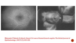 WatanabeY,Takeda N,Adachi-Usami E.A case of frosted branch angiitis.The British Journal of
Ophthalmology.1987;71(7):553-558.
 