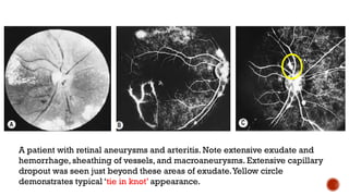 A patient with retinal aneurysms and arteritis. Note extensive exudate and
hemorrhage, sheathing of vessels, and macroaneurysms. Extensive capillary
dropout was seen just beyond these areas of exudate.Yellow circle
demonstrates typical ‘tie in knot’ appearance.
 