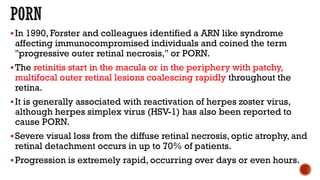 Retinal Vasculitis