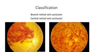 Classification
Branch retinal vein occlusion
Central retinal vein occlusion
 