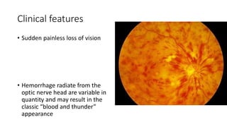 Clinical features
• Sudden painless loss of vision
• Hemorrhage radiate from the
optic nerve head are variable in
quantity and may result in the
classic “blood and thunder”
appearance
 