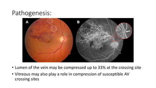 Pathogenesis:
• Lumen of the vein may be compressed up to 33% at the crossing site
• Vitreous may also play a role in compression of susceptible AV
crossing sites
 