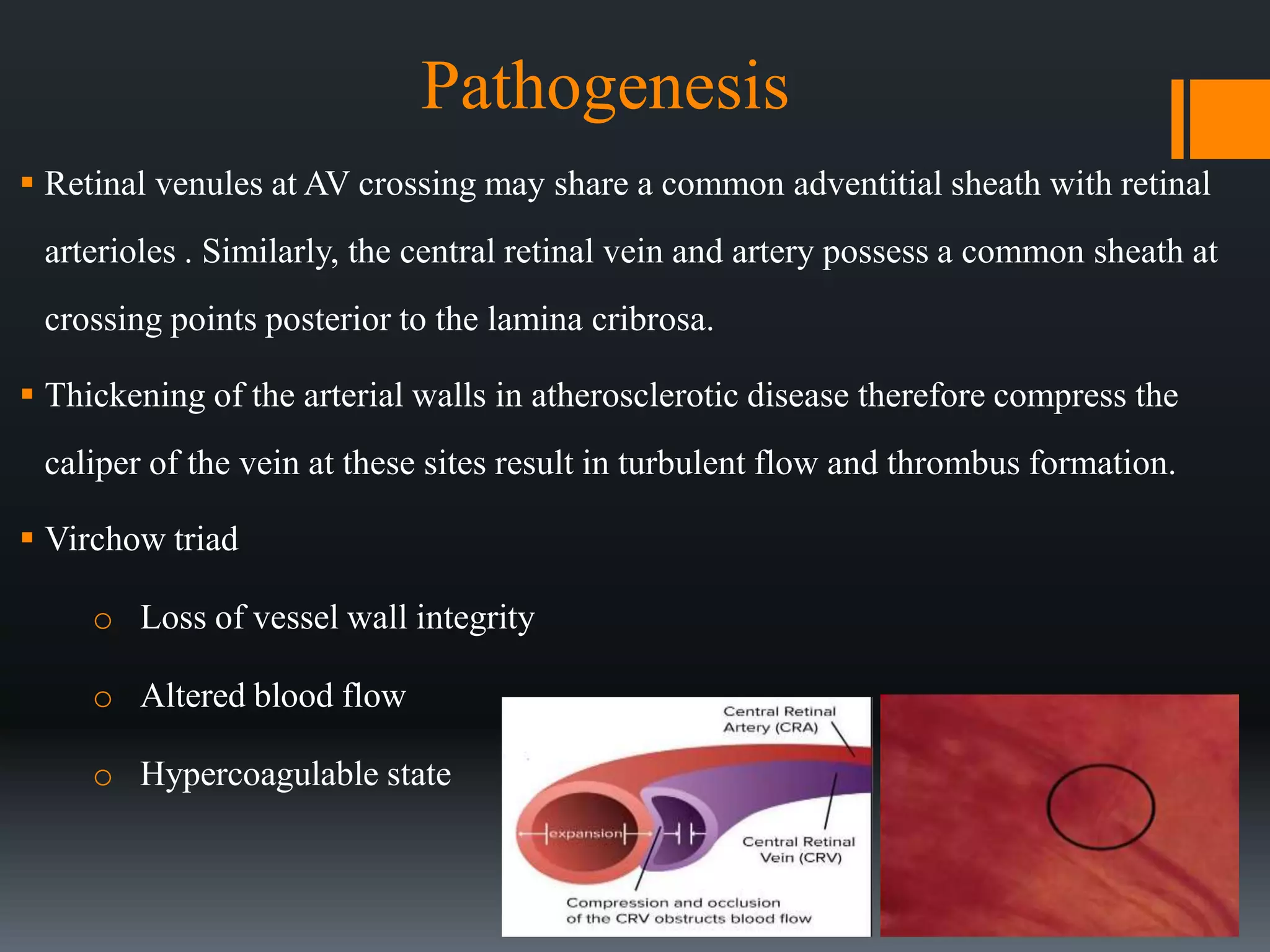 Retinal vein occlusion | PPTX