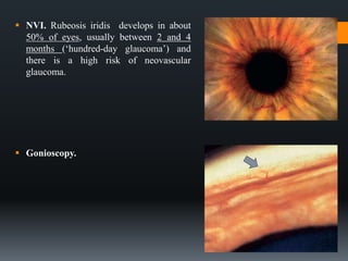 Negative Rubeosis Retinal vein occlusion | PPTX
