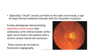 Collateral Fundus Retinal vein occlusions | PPTX