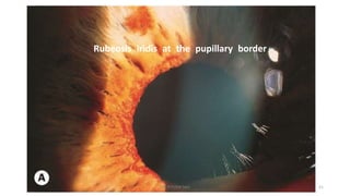 Subtle Rubeosis Retinal vein occlusions | PPTX