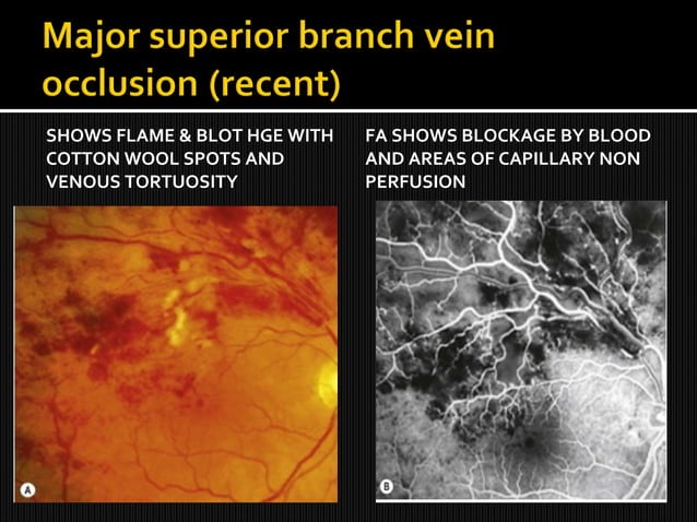 Retinal vein occlusions | PPT
