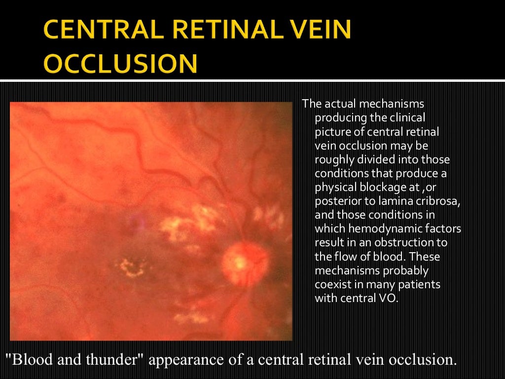 Retinal vein occlusions