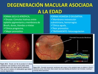 DEGENERACIÓN MACULAR ASOCIADA
A LA EDAD
FORMA SECA O ATRÓFICA,
Drusas: Cúmulos hialinos entre
epitelio pigmentario y membrana de
Bruch, duras, blandas o mixtas
Clínica progresiva,
Mejor pronostico
FORMA HÚMEDA O EXUDATIVA:
Membrana neovascular
subretiniana, hemorragias
Clínica aguda,
Peor pronostico
TRATAMIENTO: fotocoagulacion
 