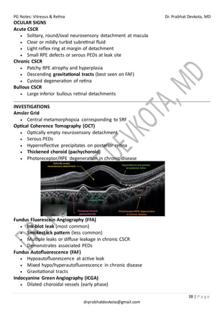 PG Notes: Vitreous & Retina Dr. Prabhat Devkota, MD
38 | P a g e
drprabhatdevkota@gmail.com
OCULAR SIGNS
Acute CSCR
• Solitary, round/oval neurosensory detachment at macula
• Clear or mildly turbid subretinal fluid
• Light reflex ring at margin of detachment
• Small RPE defects or serous PEDs at leak site
Chronic CSCR
• Patchy RPE atrophy and hyperplasia
• Descending gravitational tracts (best seen on FAF)
• Cystoid degeneration of retina
Bullous CSCR
• Large inferior bullous retinal detachments
INVESTIGATIONS
Amsler Grid
• Central metamorphopsia corresponding to SRF
Optical Coherence Tomography (OCT)
• Optically empty neurosensory detachment
• Serous PEDs
• Hyperreflective precipitates on posterior retina
• Thickened choroid (pachychoroid)
• Photoreceptor/RPE degeneration in chronic disease
Fundus Fluorescein Angiography (FFA)
• Ink-blot leak (most common)
• Smokestack pattern (less common)
• Multiple leaks or diffuse leakage in chronic CSCR
• Demonstrates associated PEDs
Fundus Autofluorescence (FAF)
• Hypoautofluorescence at active leak
• Mixed hypo/hyperautofluorescence in chronic disease
• Gravitational tracts
Indocyanine Green Angiography (ICGA)
• Dilated choroidal vessels (early phase)
 