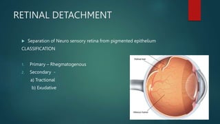 RETINA-retinal detatchment powerpoint presentation | PPTX