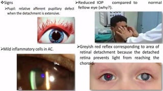 Retina retinal detachment